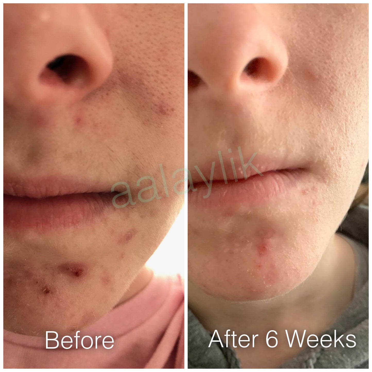 All-natural Mirekal Oil for eczema, psoriasis, and dry skin, suitable for babies and adults; award-winning skincare solution for soothing and healing irritated skin.