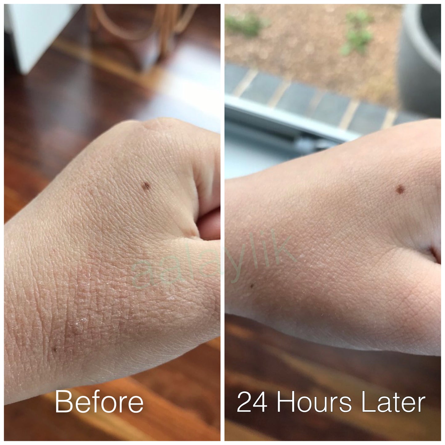All-natural Mirekal Oil for eczema, psoriasis, and dry skin, suitable for babies and adults; award-winning skincare solution for soothing and healing irritated skin.