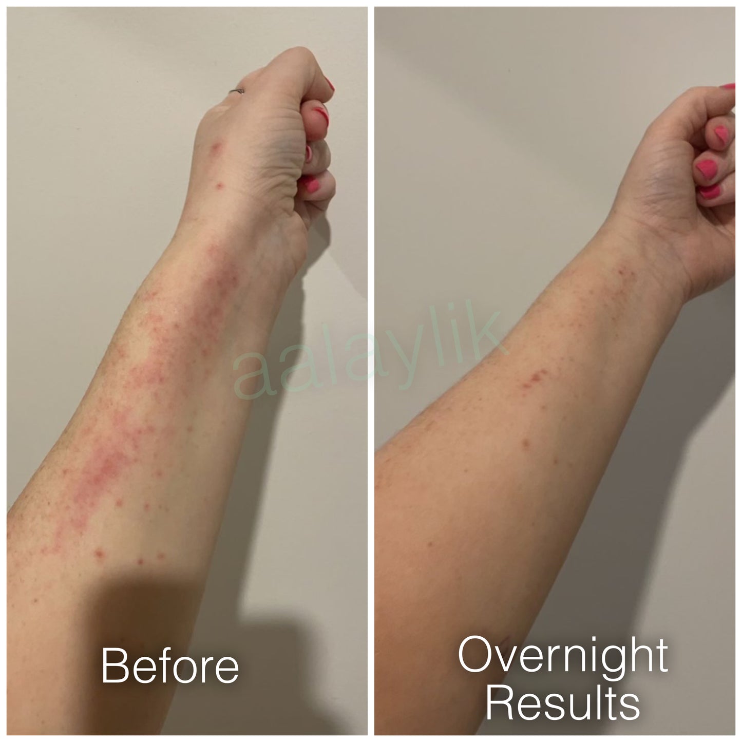 All-natural Mirekal Oil for eczema, psoriasis, and dry skin, suitable for babies and adults; award-winning skincare solution for soothing and healing irritated skin.