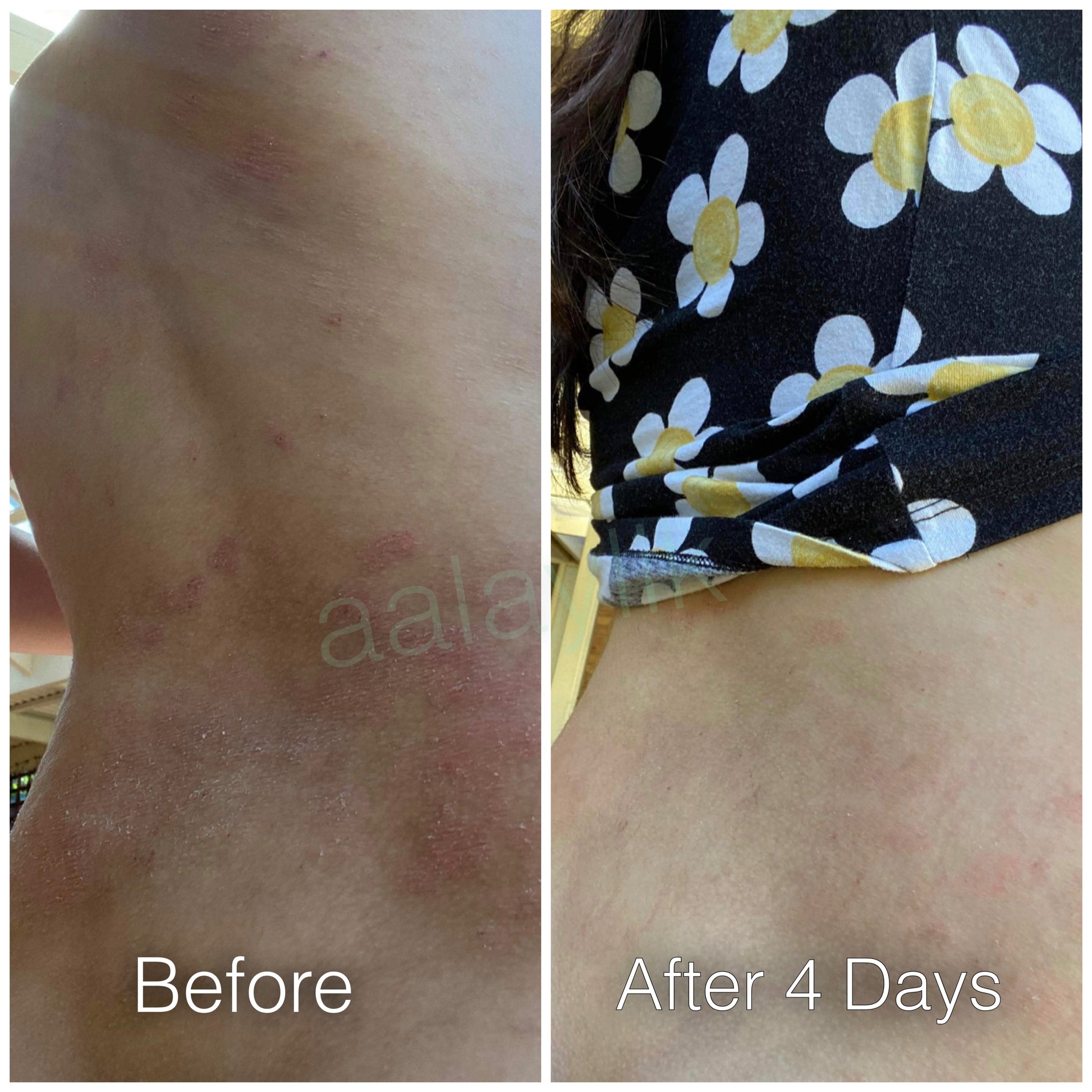 All-natural Mirekal Oil for eczema, psoriasis, and dry skin, suitable for babies and adults; award-winning skincare solution for soothing and healing irritated skin.